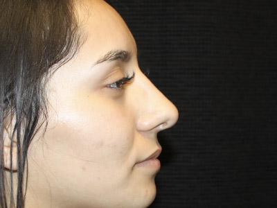 Patient #27507: Rhinoplasty After Image