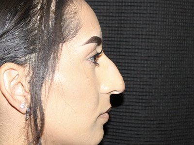 Patient #27507: Rhinoplasty Before Image