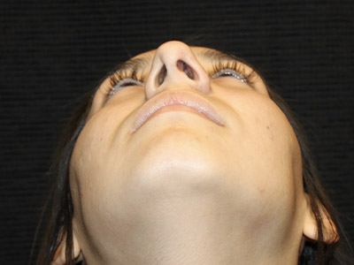 Patient #27507: Rhinoplasty After Image