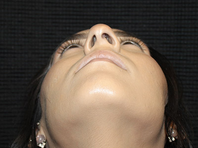 Patient #27507: Rhinoplasty Before Image