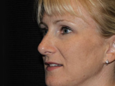 Patient #42296: Rhinoplasty After Image