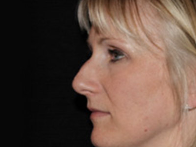 Patient #42296: Rhinoplasty Before Image