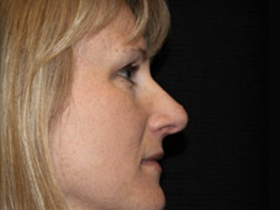 Patient #42296: Rhinoplasty After Image