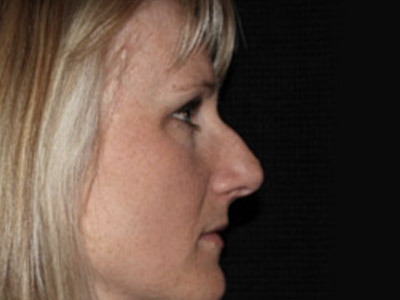 Patient #42296: Rhinoplasty Before Image