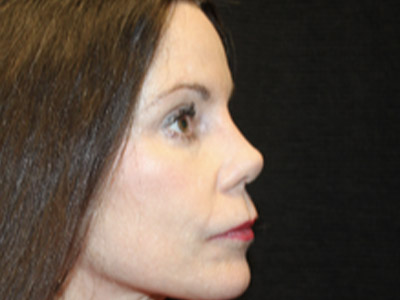 Patient #42396: Rhinoplasty After Image