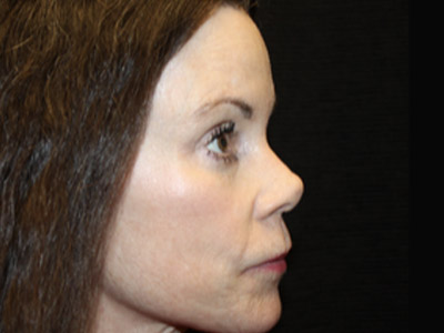 Patient #42396: Rhinoplasty Before Image