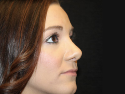 Patient #47719: Rhinoplasty After Image