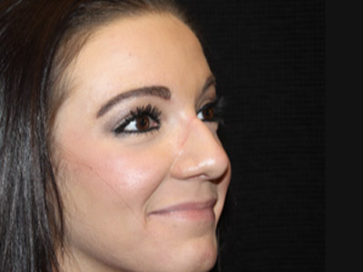 Patient #47719: Rhinoplasty Before Image