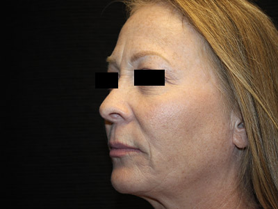 Patient #84041: Rhinoplasty After Image