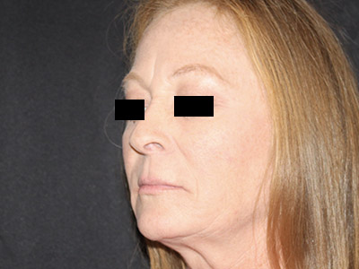 Patient #84041: Rhinoplasty Before Image