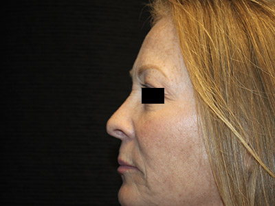 Patient #84041: Rhinoplasty After Image