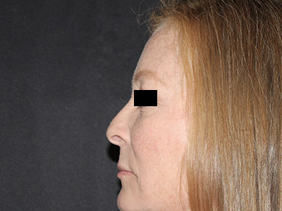 Patient #84041: Rhinoplasty Before Image