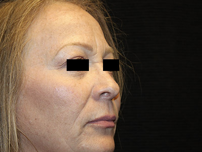 Patient #84041: Rhinoplasty After Image