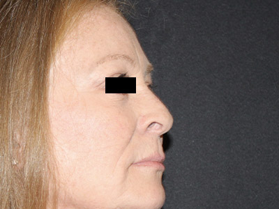 Patient #84041: Rhinoplasty Before Image