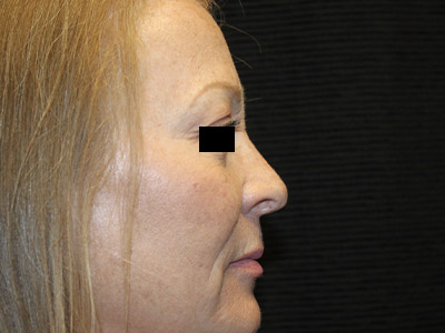 Patient #84041: Rhinoplasty After Image