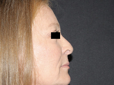 Patient #84041: Rhinoplasty Before Image