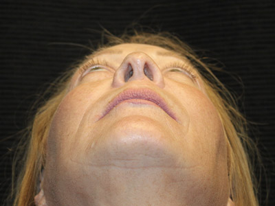 Patient #84041: Rhinoplasty After Image