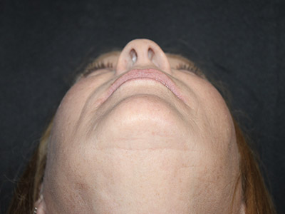 Patient #84041: Rhinoplasty Before Image