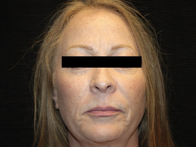Patient #84041: Rhinoplasty After Image