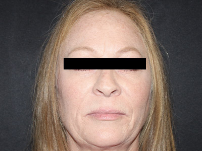 Patient #84041: Rhinoplasty Before Image