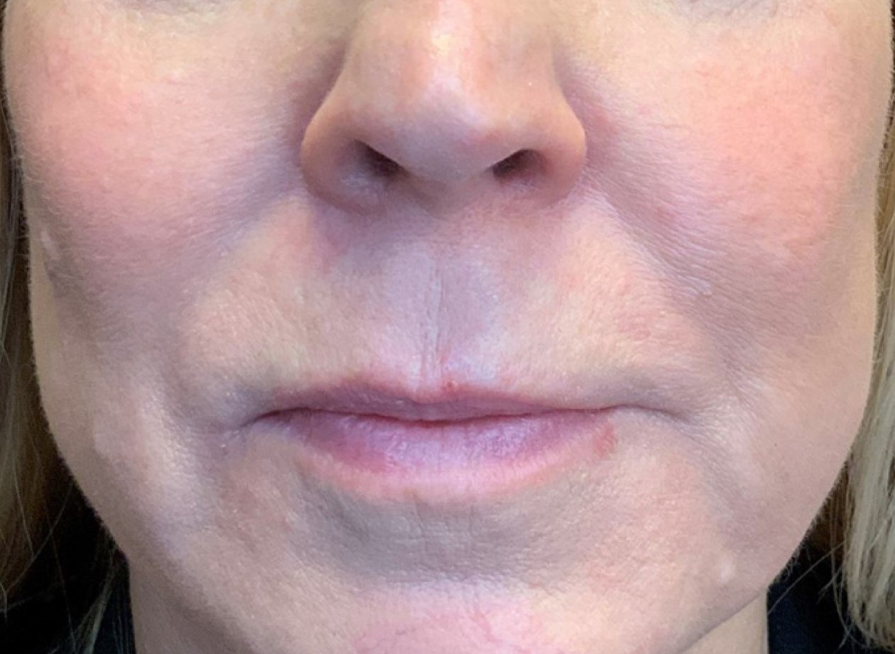Patient #13347: IPL for Brown Spots After Image