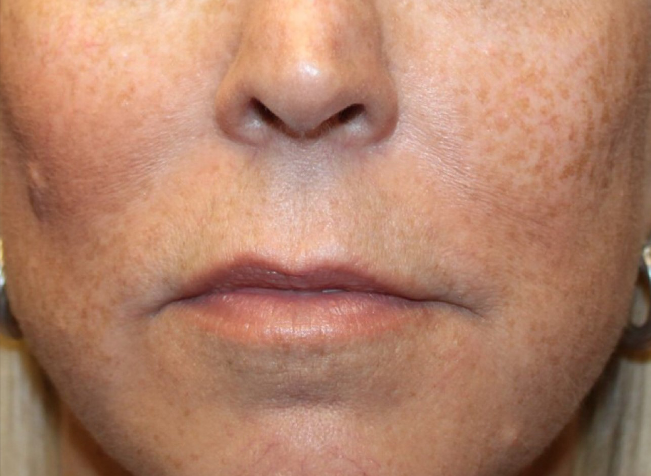 Patient #13347: IPL for Brown Spots Before Image