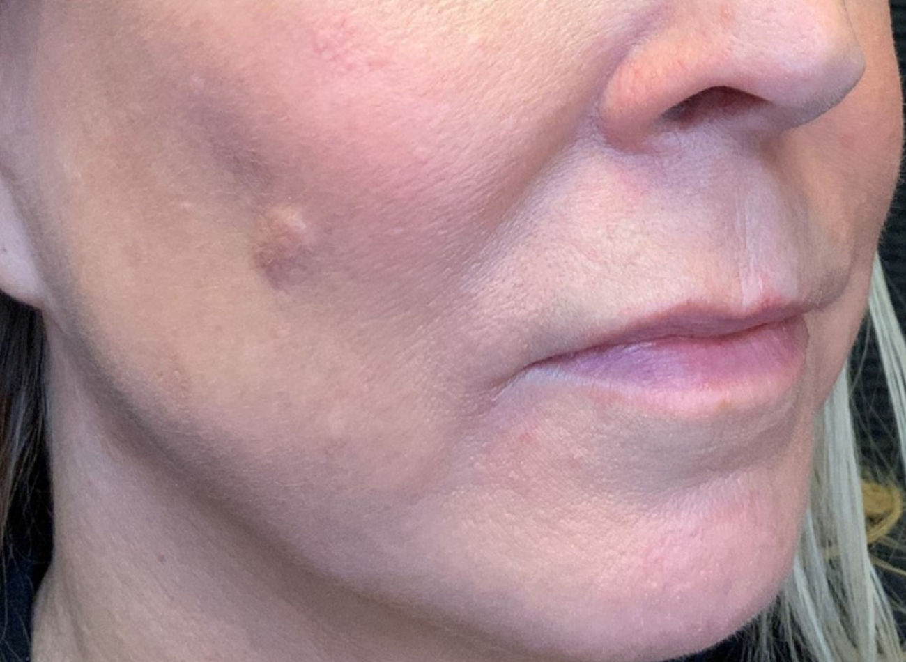 Patient #13347: IPL for Brown Spots After Image