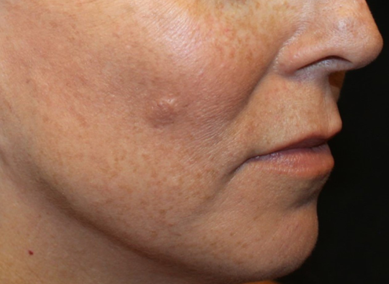 Patient #13347: IPL for Brown Spots Before Image