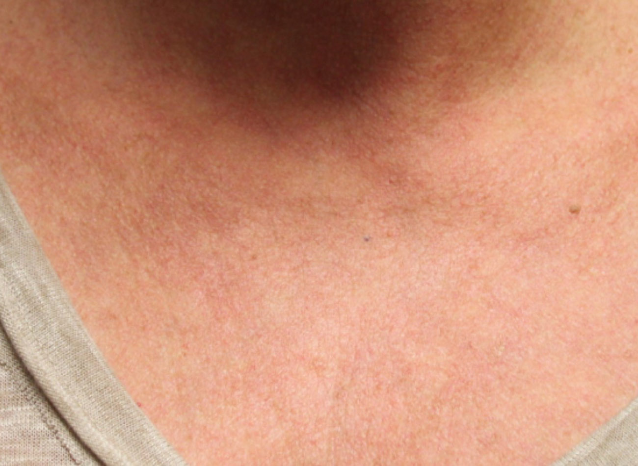 Patient #18035: IPL for Brown Spots After Image