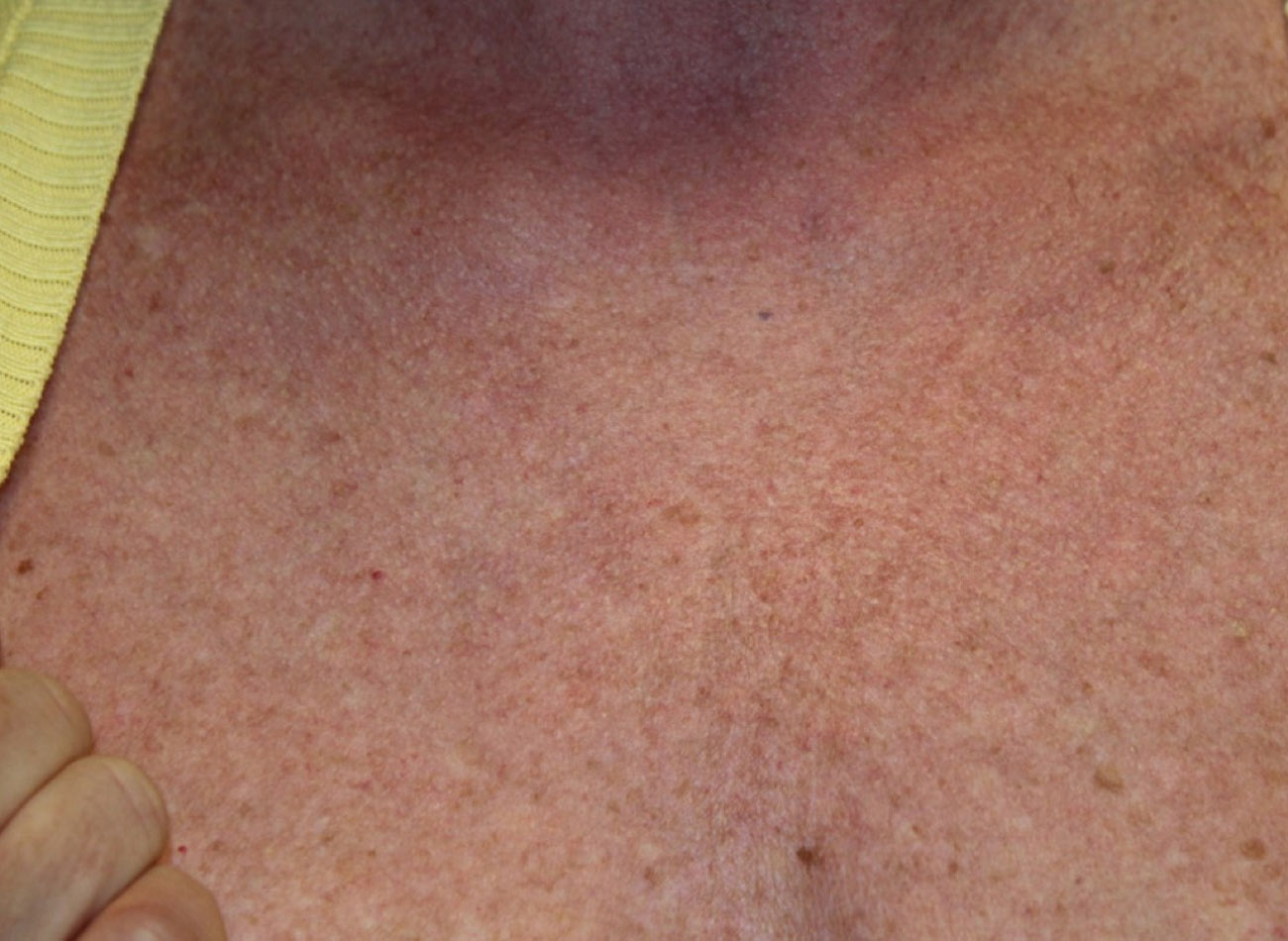 Patient #18035: IPL for Brown Spots Before Image