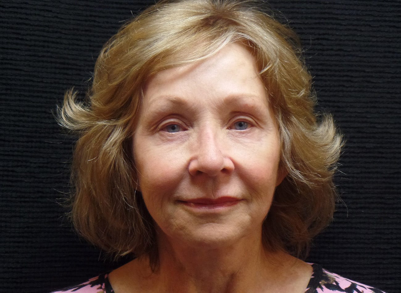 Patient #43543: Voluma After Image