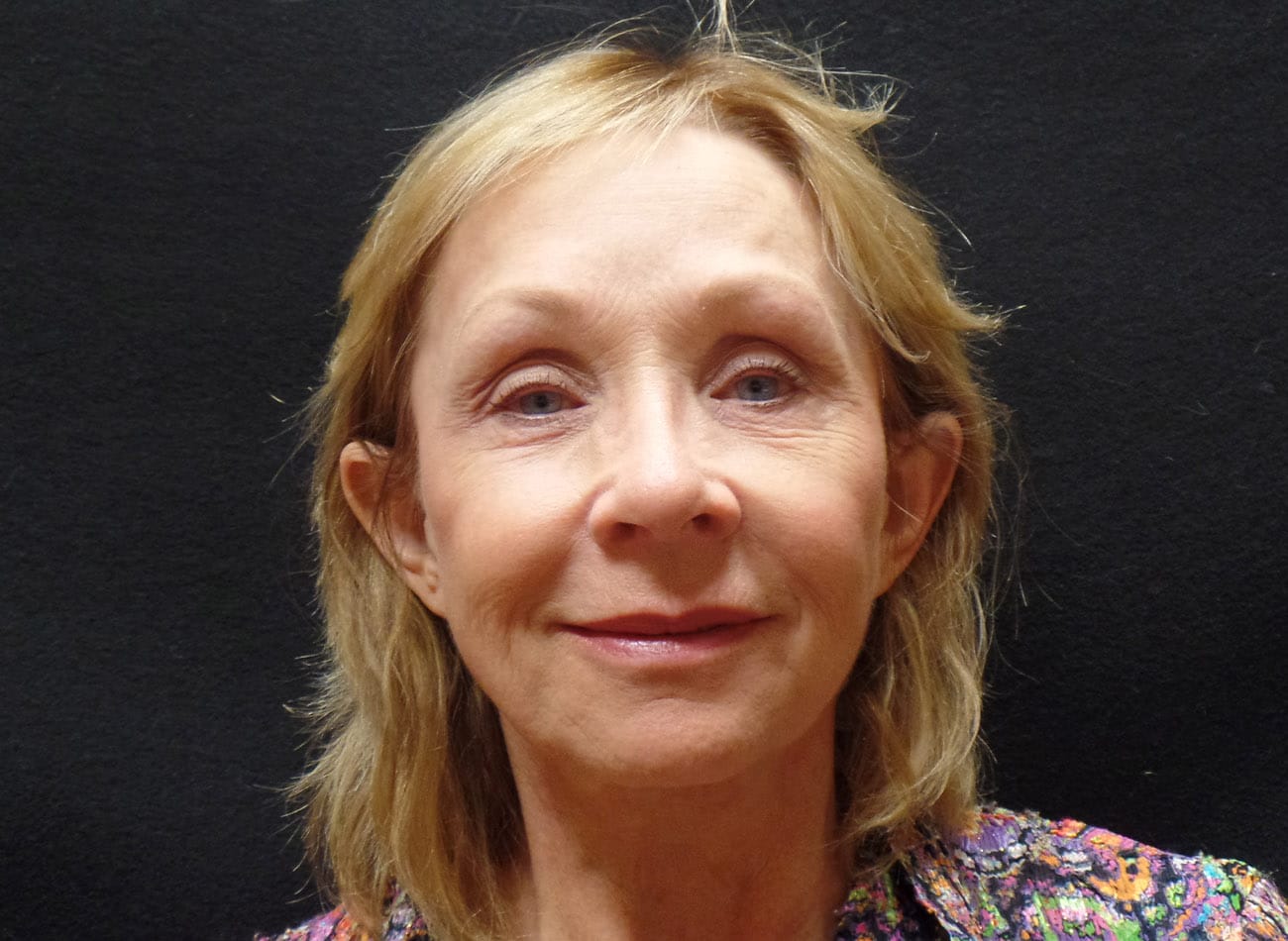 Patient #43543: Voluma Before Image