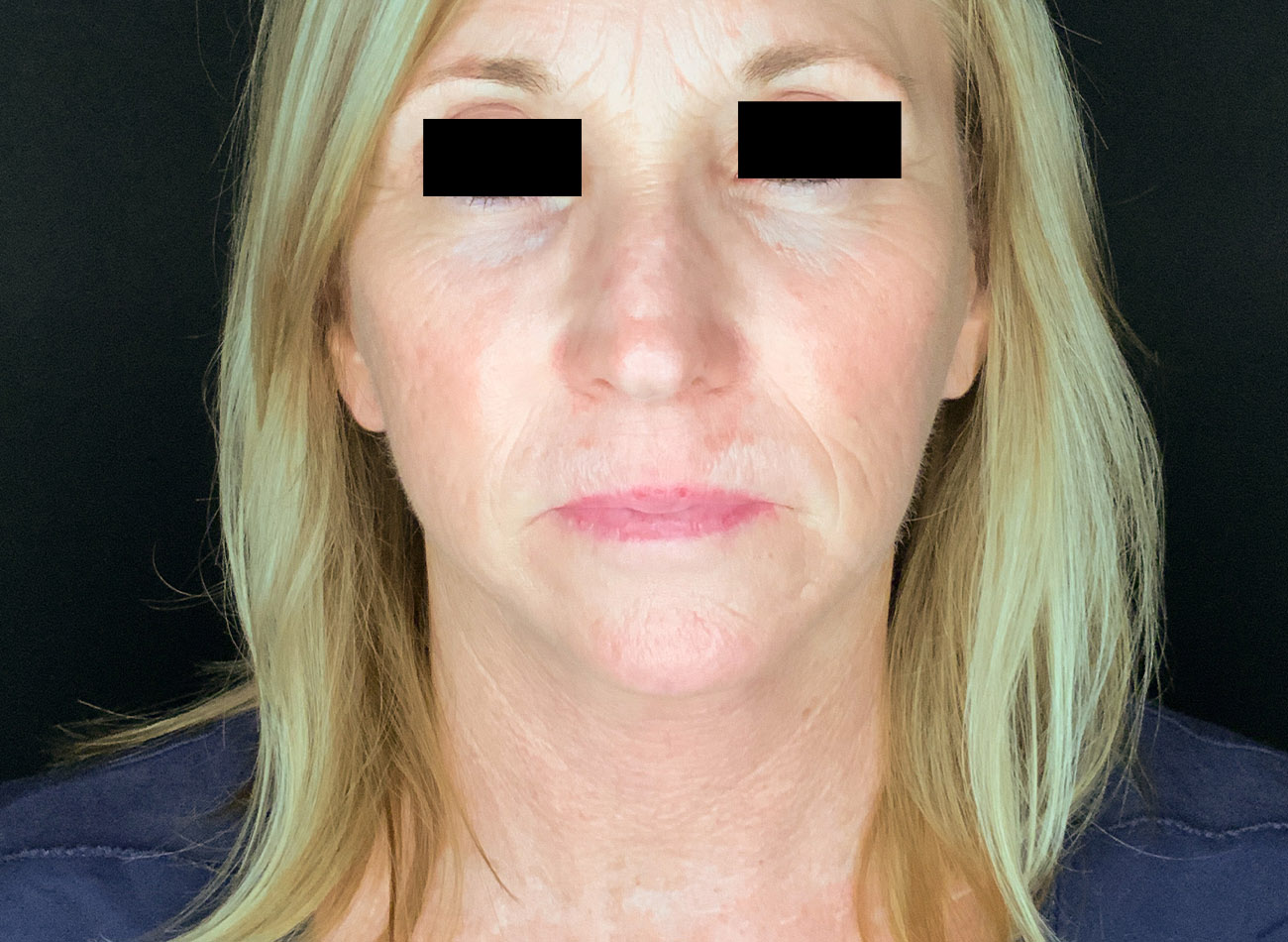 Patient #47456: CO2 Laser After Image