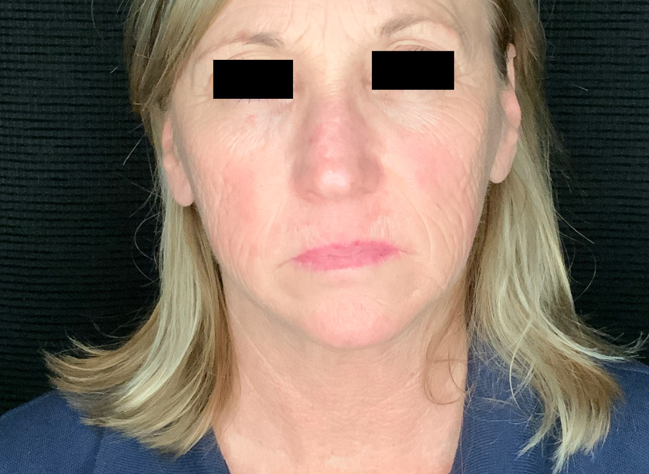Patient #47456: CO2 Laser Before Image