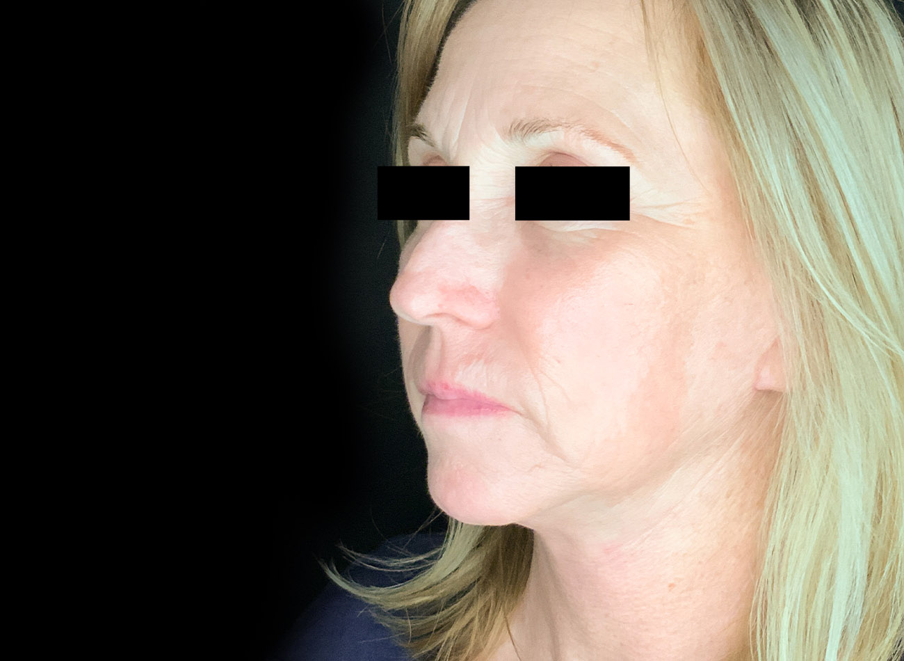 Patient #47456: CO2 Laser After Image