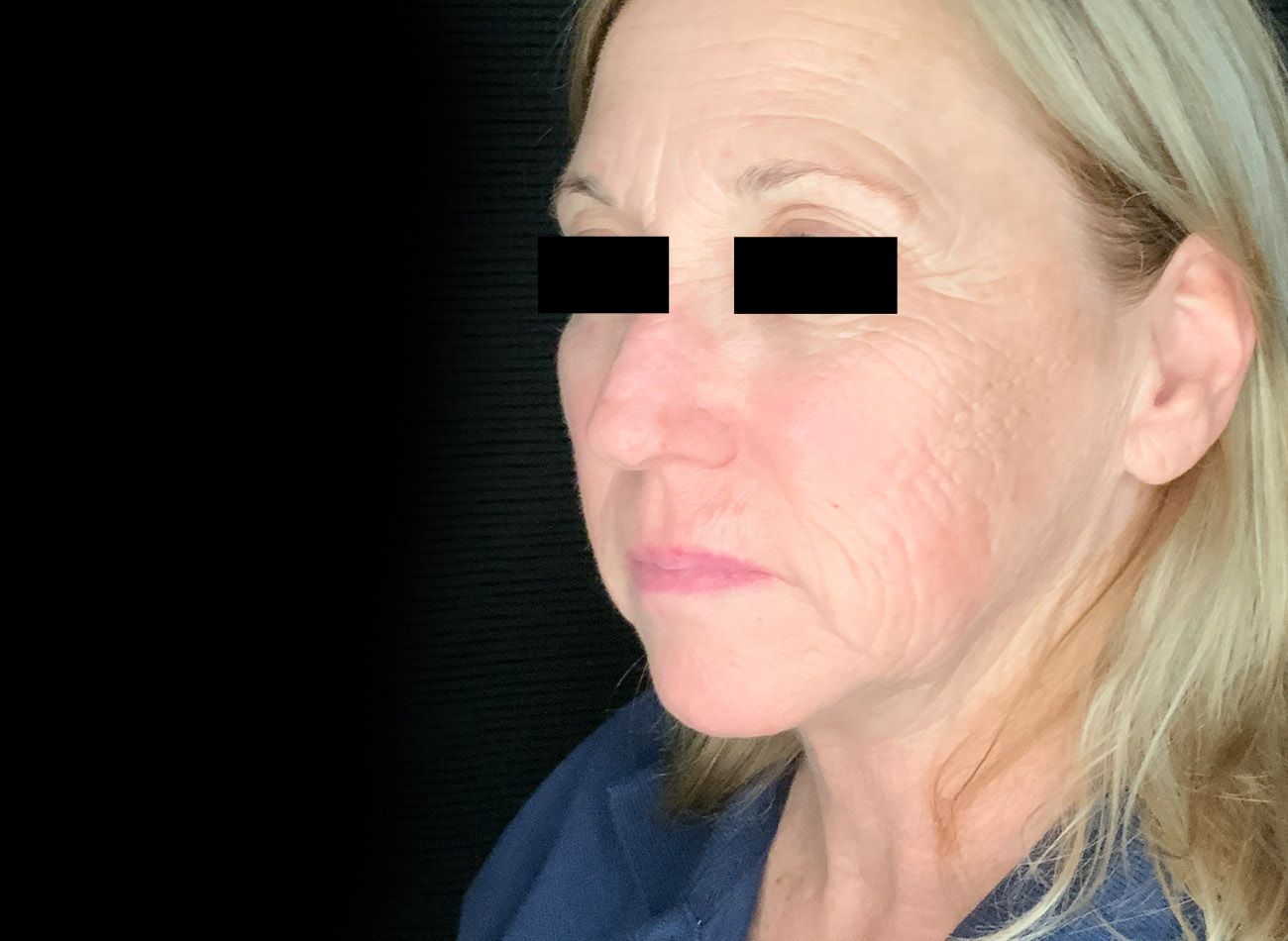 Patient #47456: CO2 Laser Before Image
