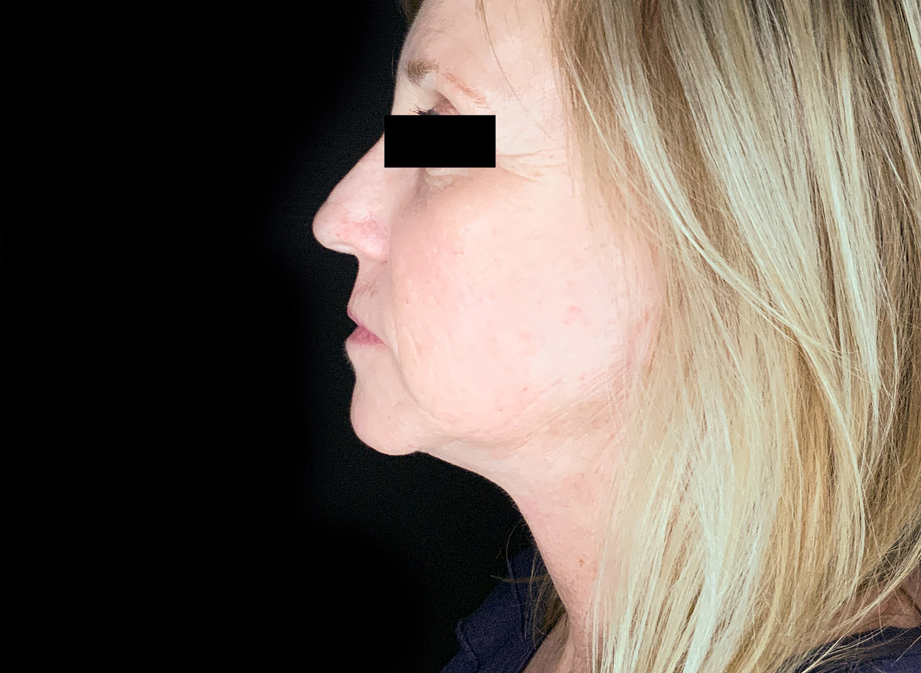 Patient #47456: CO2 Laser After Image