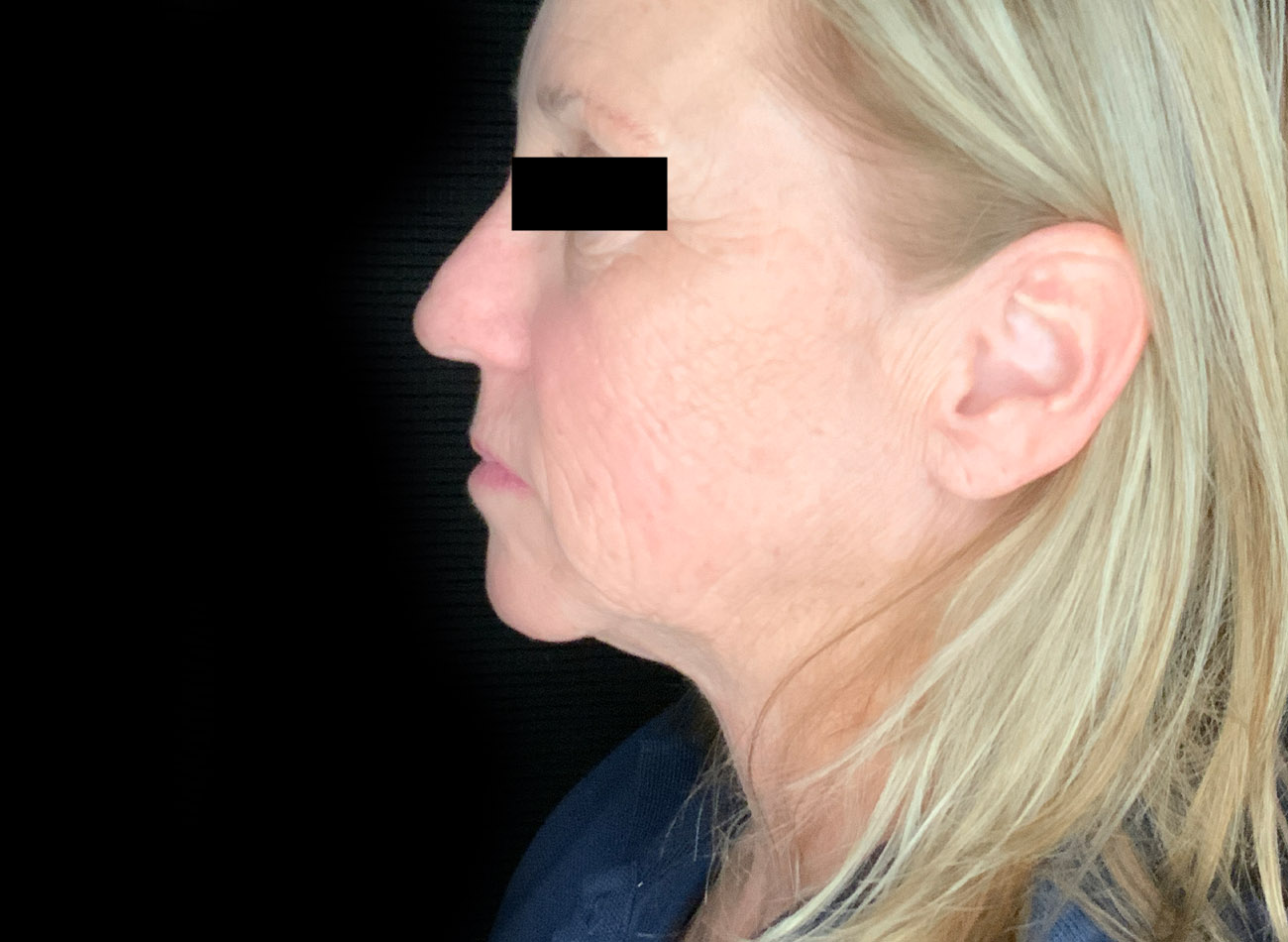 Patient #47456: CO2 Laser Before Image