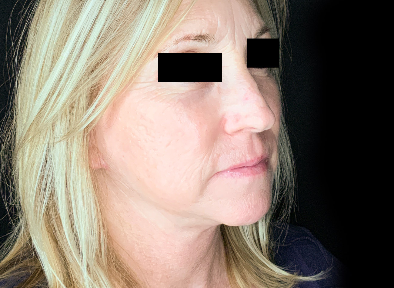 Patient #47456: CO2 Laser After Image