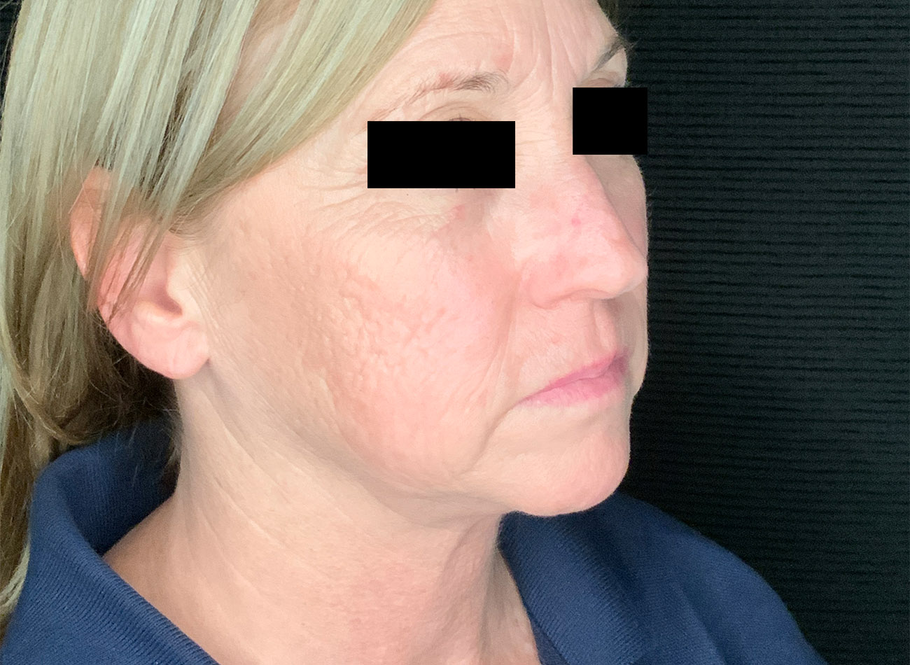 Patient #47456: CO2 Laser Before Image