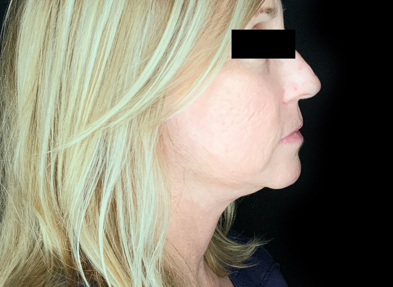 Patient #47456: CO2 Laser After Image