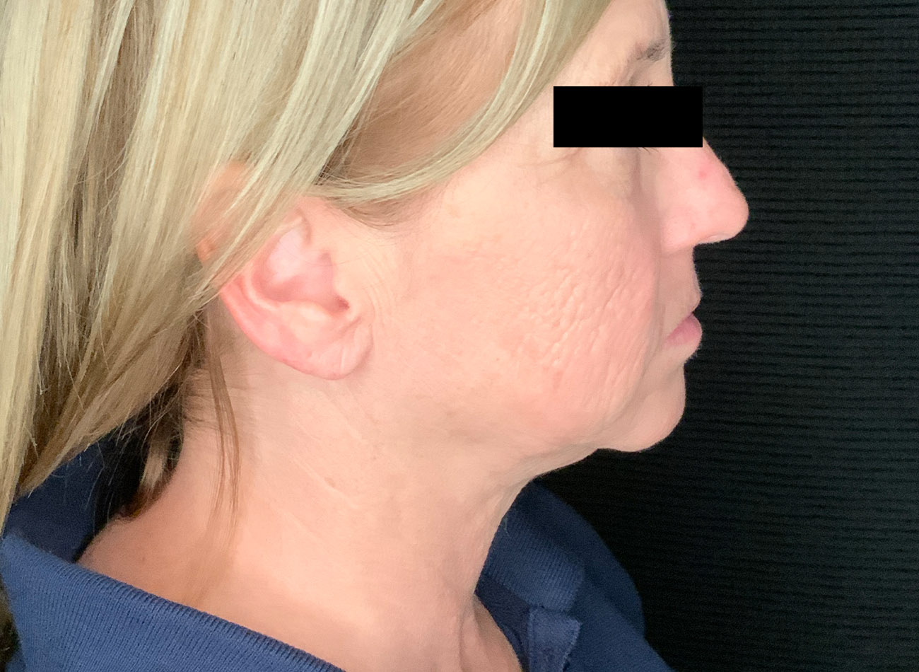 Patient #47456: CO2 Laser Before Image