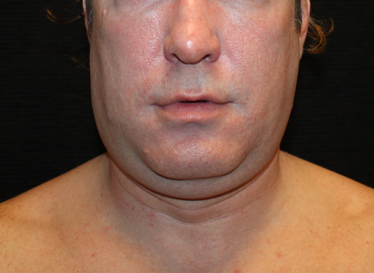 Patient #65839-1: CoolSculpting Before Image