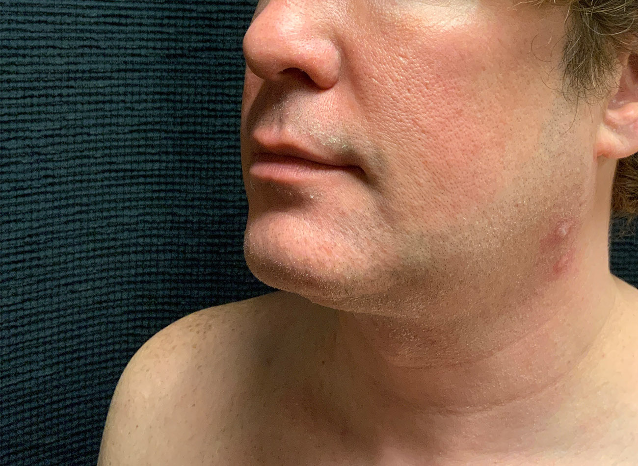 Patient #65839-1: CoolSculpting After Image