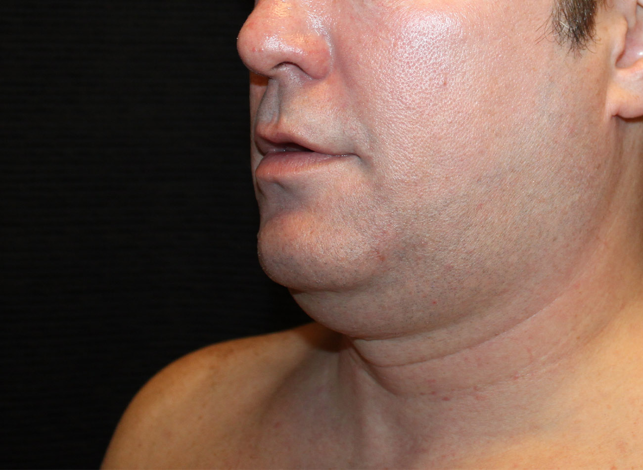 Patient #65839-1: CoolSculpting Before Image