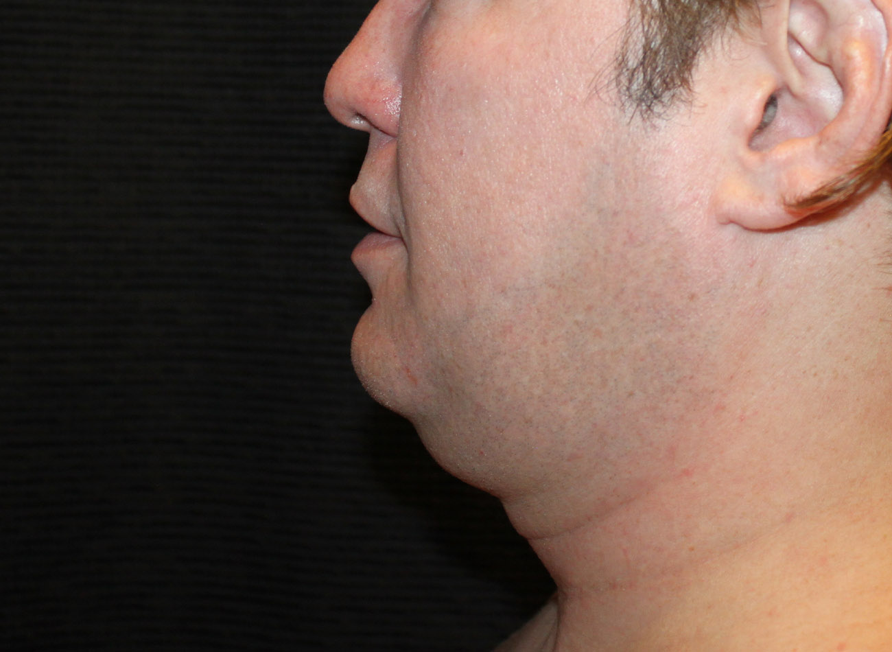 Patient #65839-1: CoolSculpting Before Image
