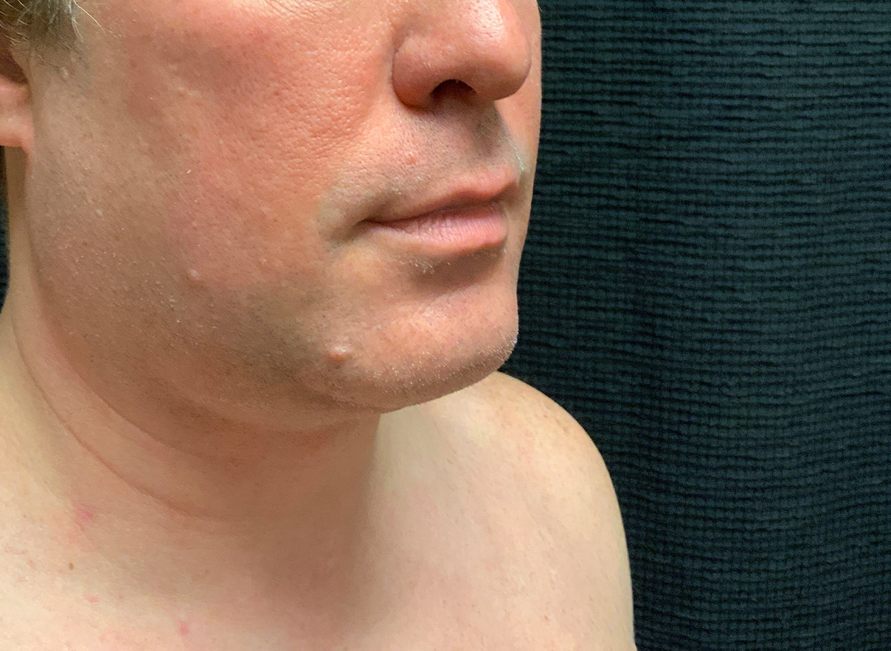Patient #65839-1: CoolSculpting After Image