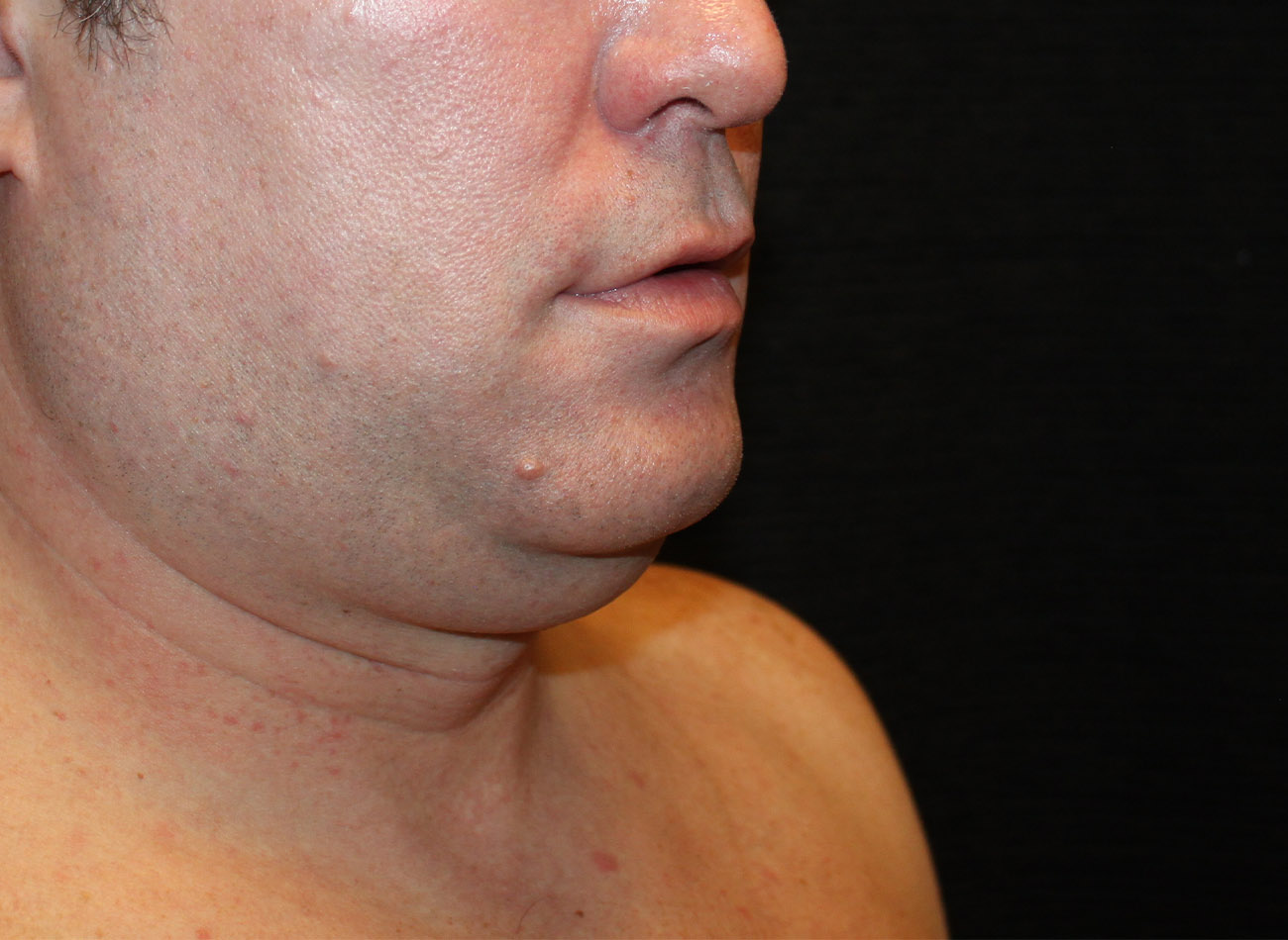 Patient #65839-1: CoolSculpting Before Image