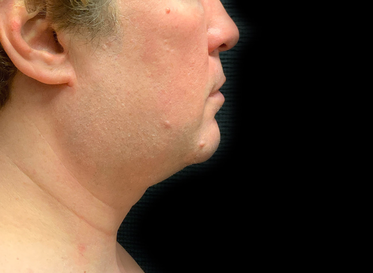 Patient #65839-1: CoolSculpting After Image