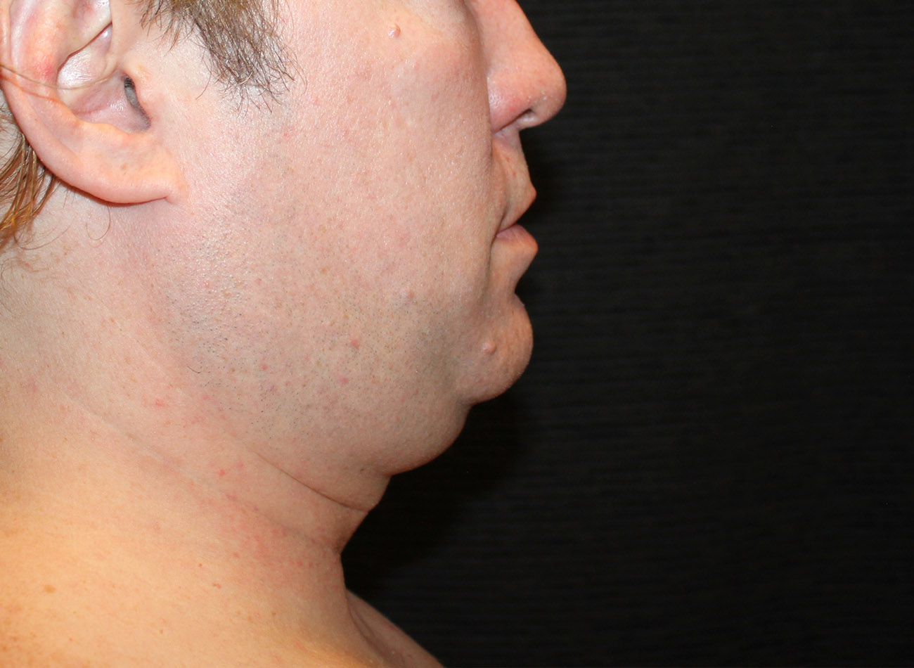 Patient #65839-1: CoolSculpting Before Image
